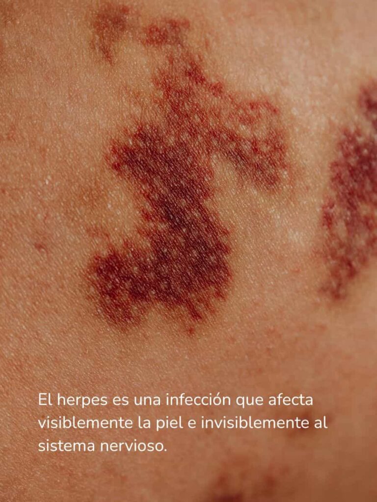 herpes infección de la piel