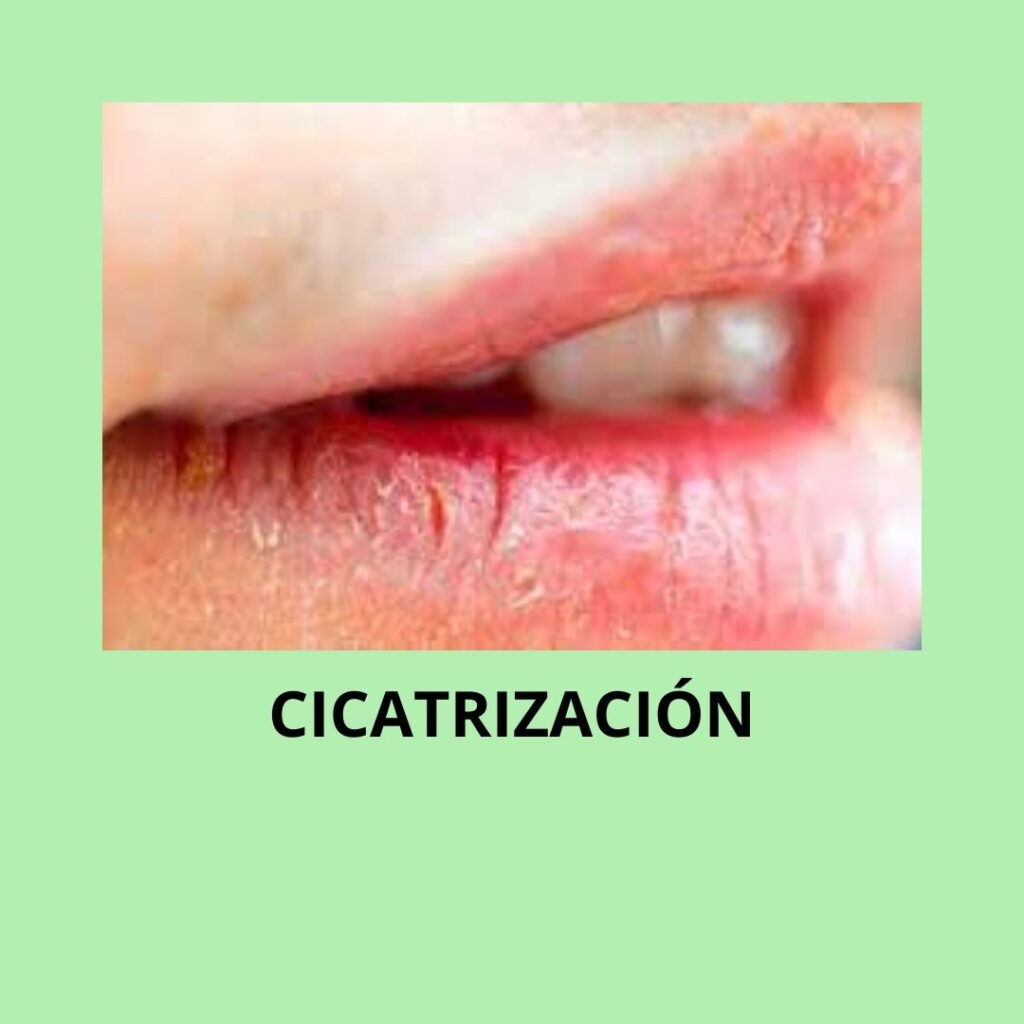 como comienza un brote de herpes